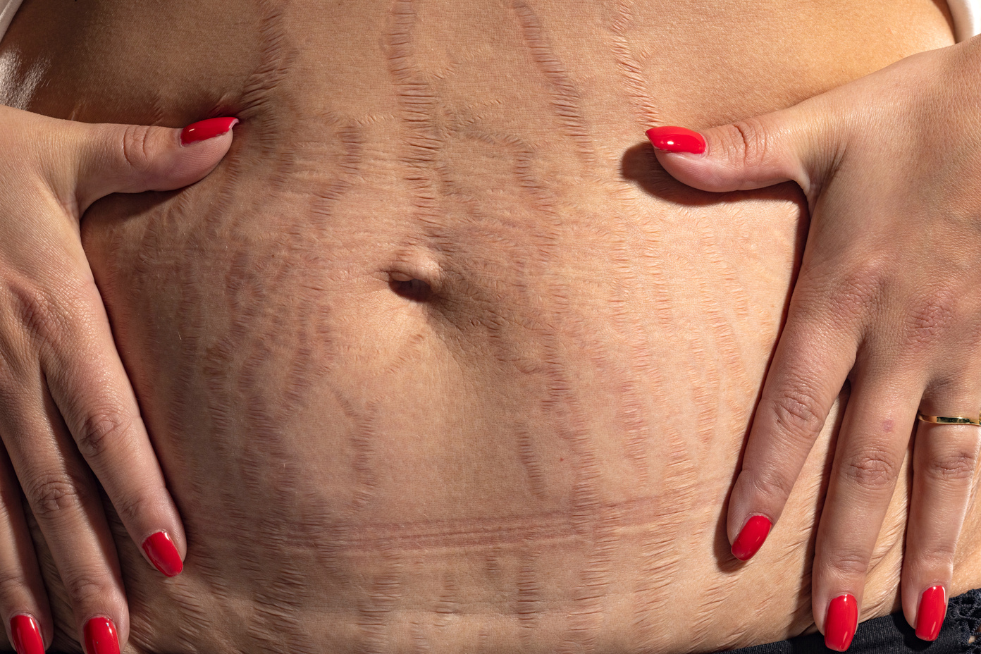 Woman displaying loose skin and stretch marks after pregnancy